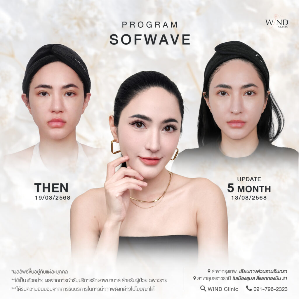 Sofwave Before & After