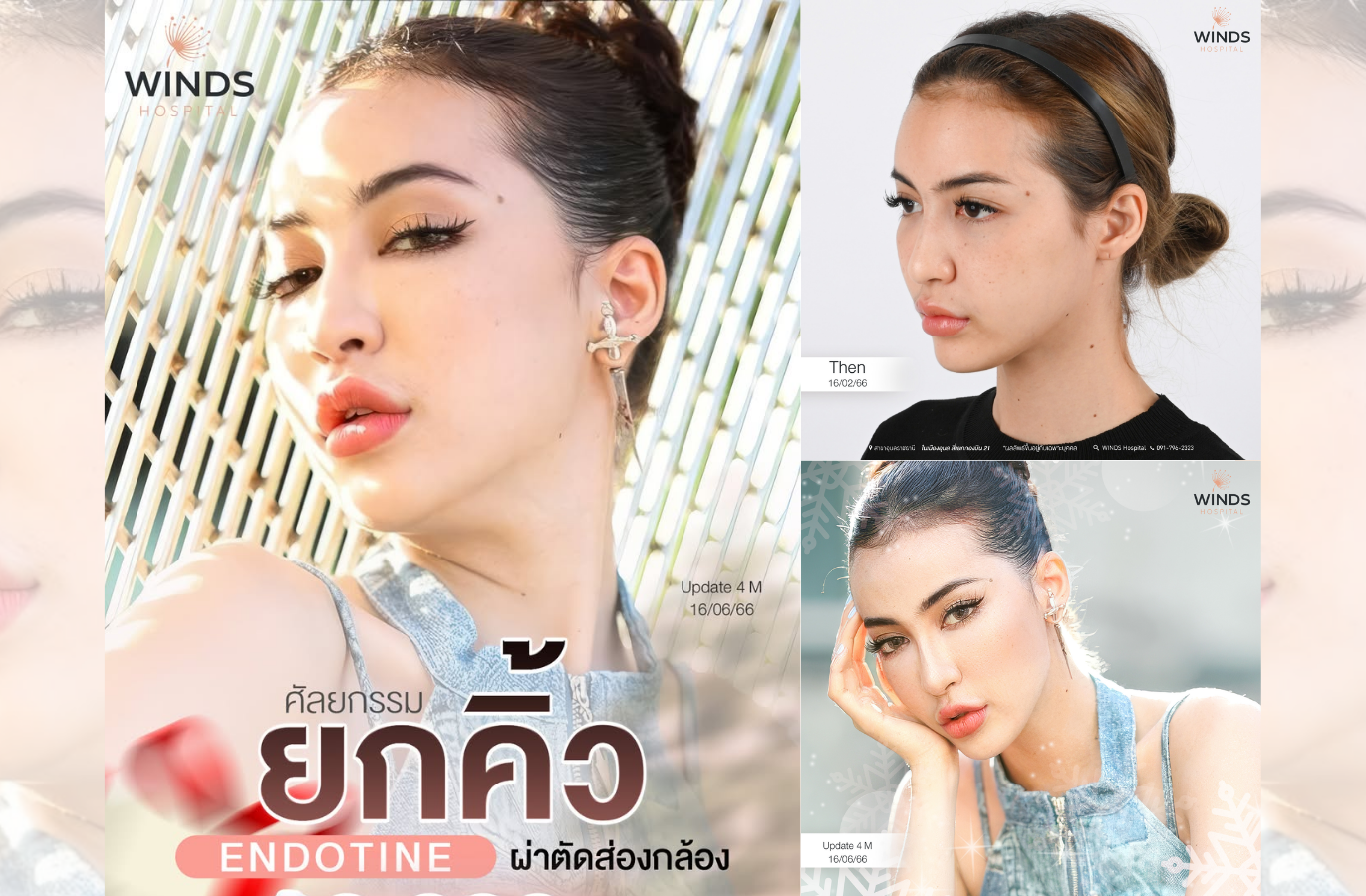 ศัลยกรรมยกคิ้ว Endotine